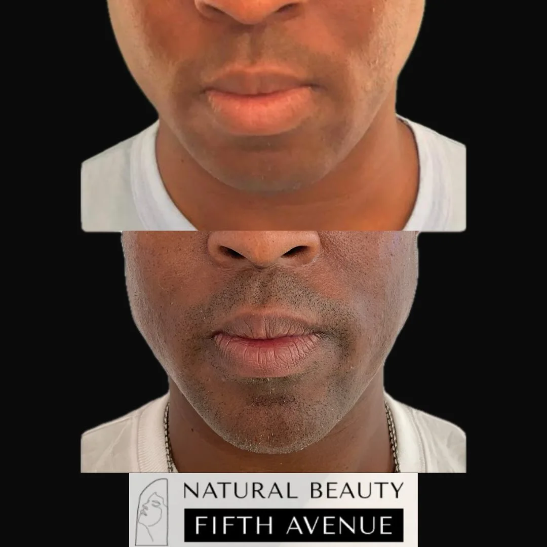 Before and after dermal filler treatment showing fuller lips and enhanced facial contours